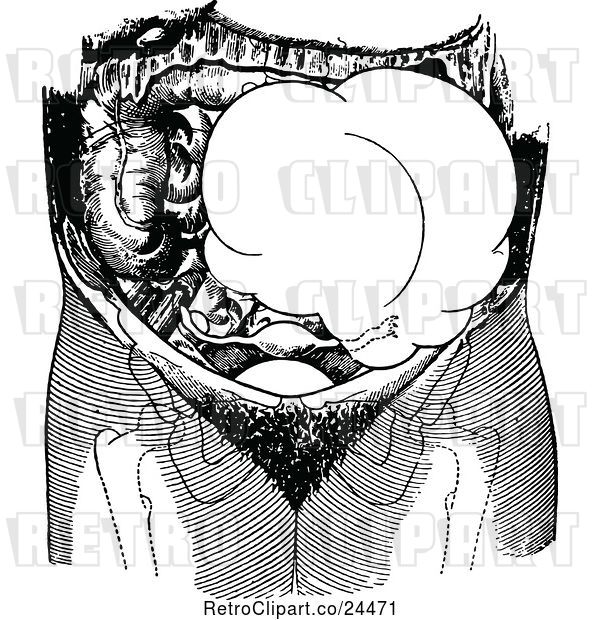 Vector Clip Art of Retro Ovarian Tumor on the Left Side of the Pelvis
